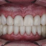 Exploring the Suitability of All-on-4 Implants for Smile Restoration